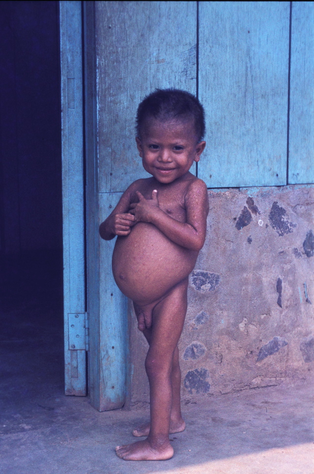 Nicaragua 1982-83 Waslala malnutrito